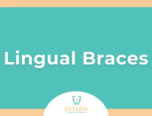 Lingual Braces in North Miami Beach