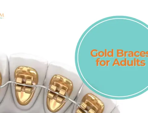 Gold Braces for Adults in North Miami Beach